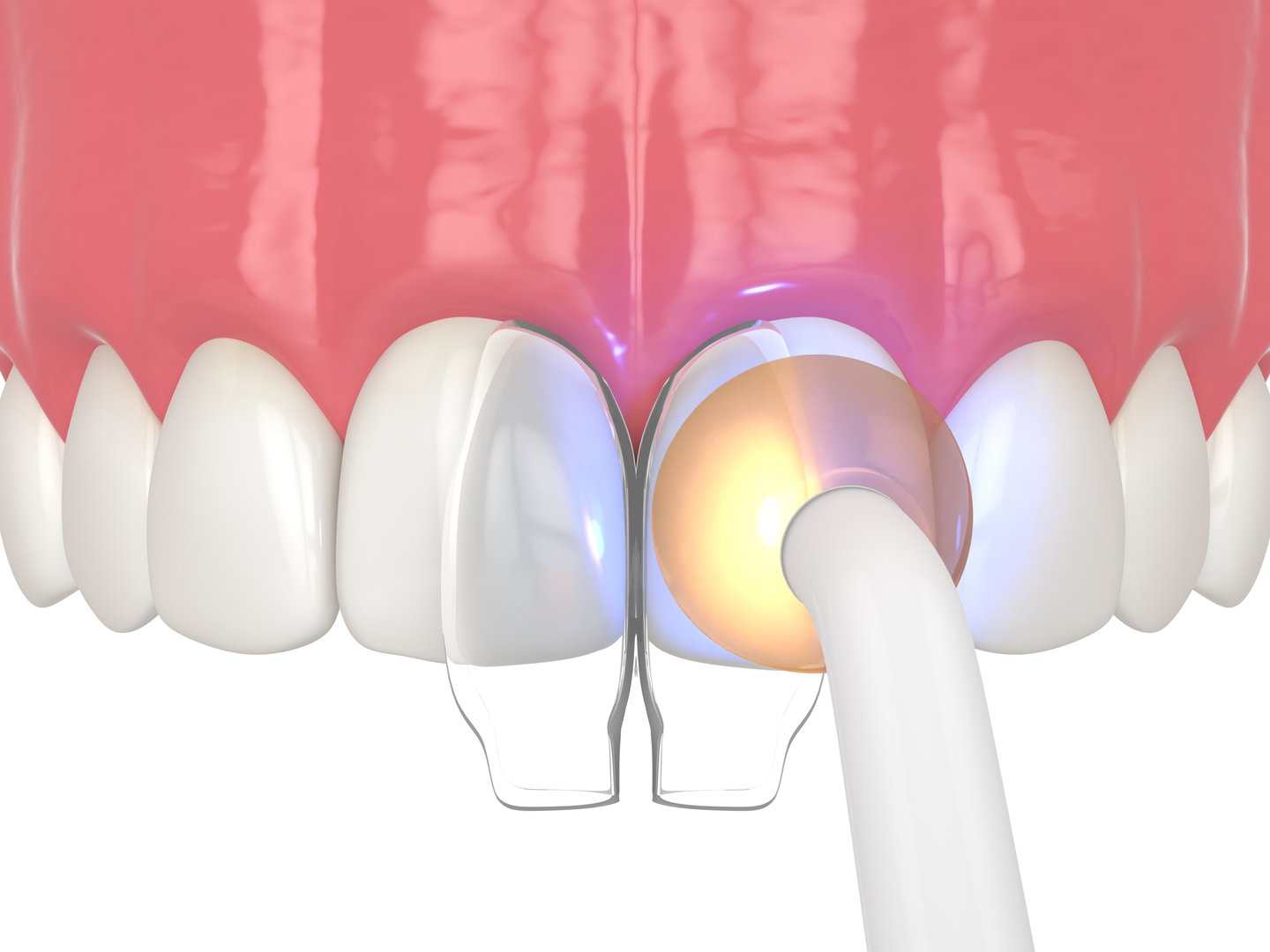 dental-bonding-near-me1