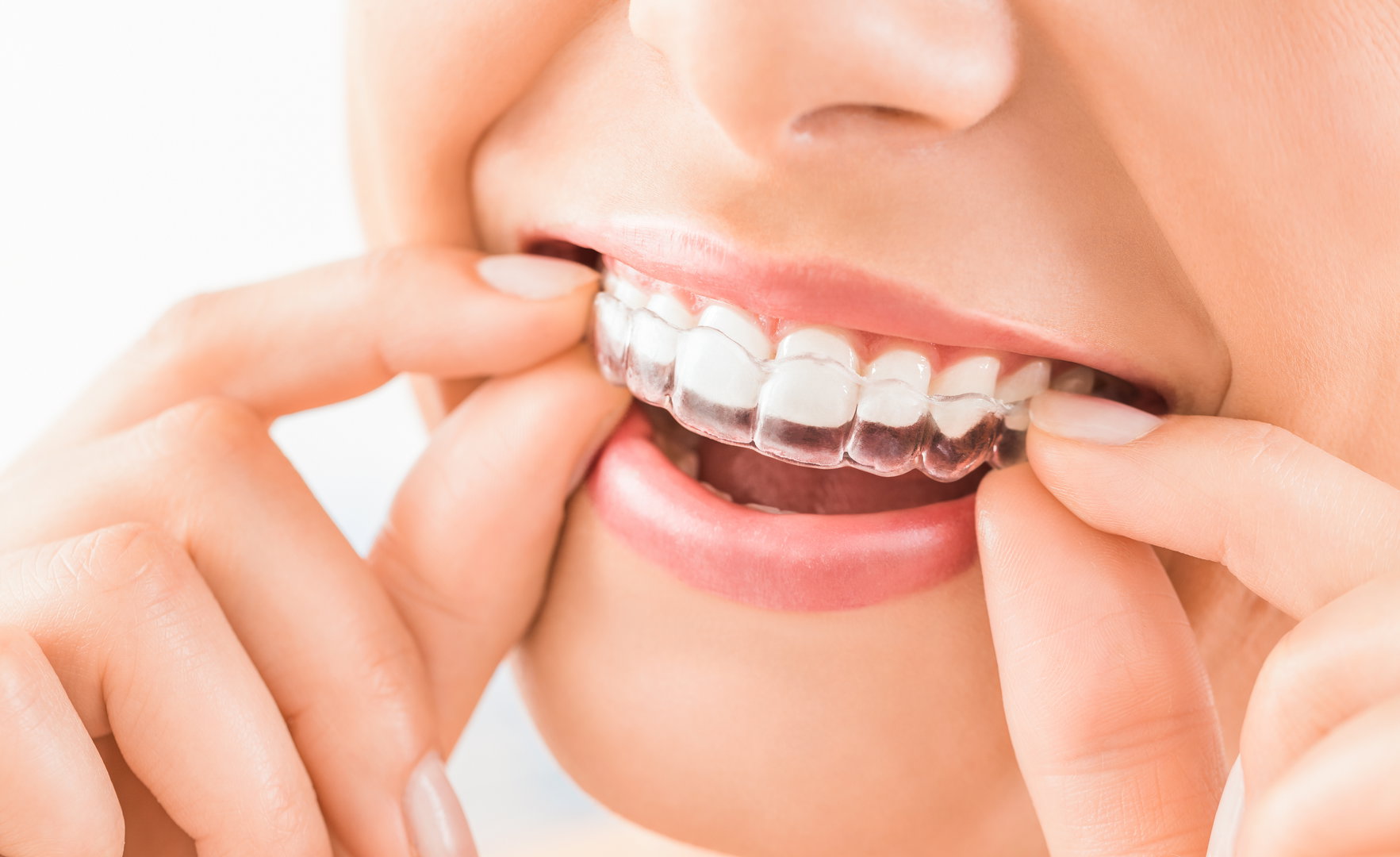 invisalign2
