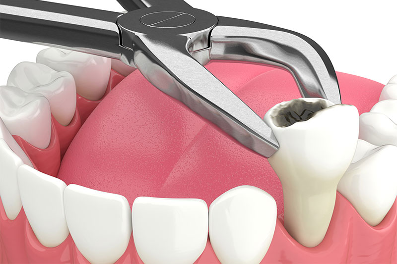 Tooth Extraction in Reston