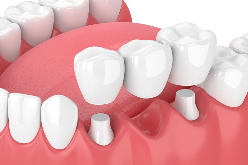 Dental Bridges in Reston