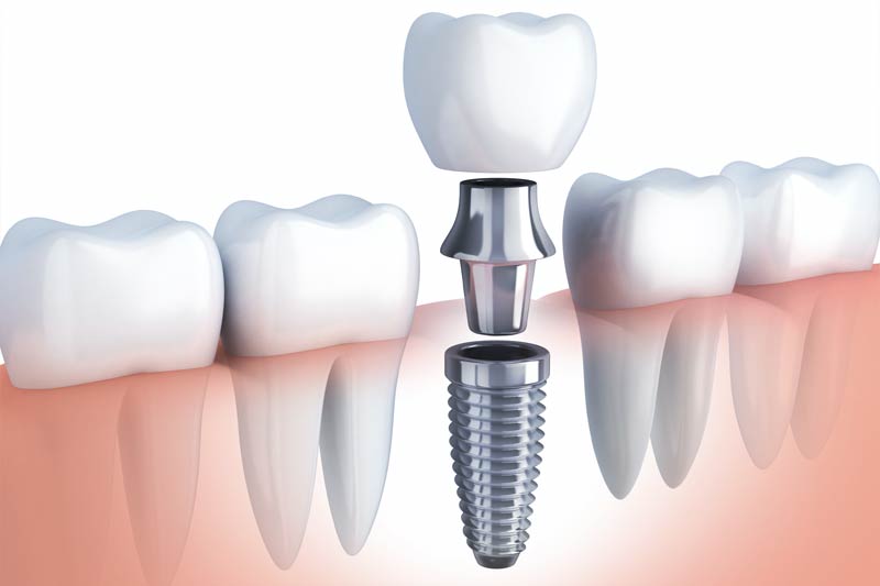 Implants Dentist in Reston