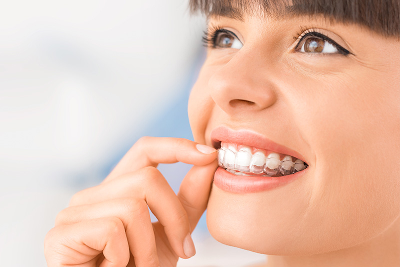 Invisalign in Reston