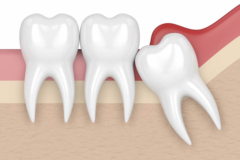 Wisdom Tooth Removal in Reston